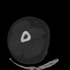 SPORK, NICO - 22.03.1976 - 02.08.2022 - CT obere Extremität - 17:51:17